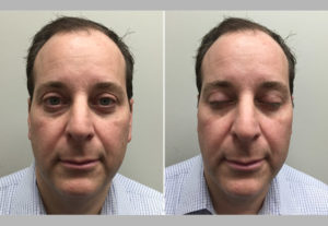 Lower Blepharoplasty Before & After Photos | Cohen Plastic Surgery