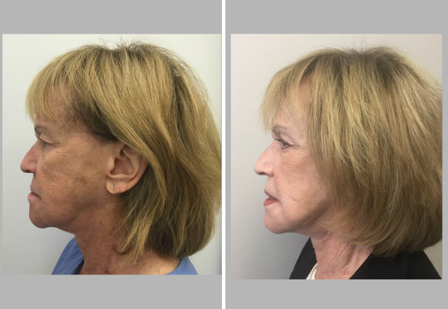 Upper and Lower Blepharoplasty right side view