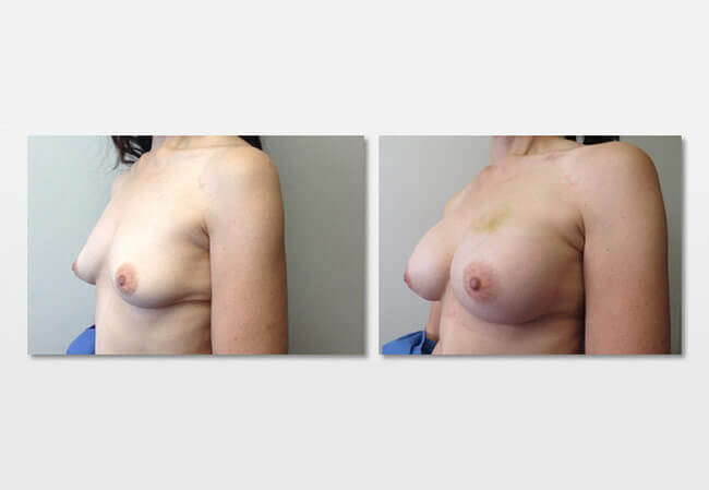 Breast Augmentation Case 4 right side view