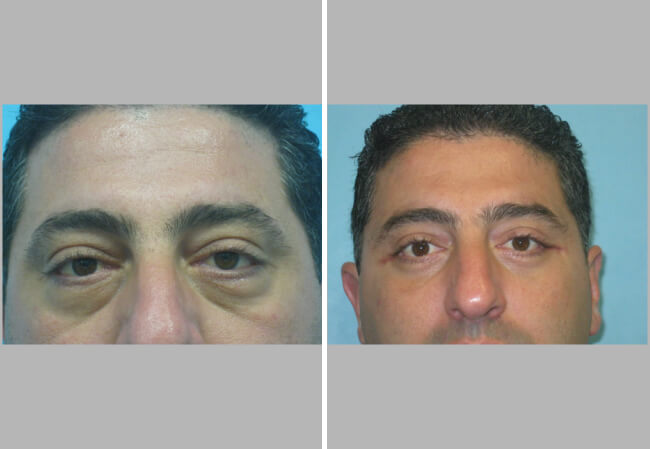 Lower Blepharoplasty - Case 1 frontal view