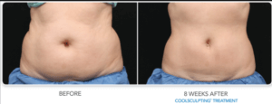 CoolSculpting®for Men Boston, Non-Surgical Fat Reduction Wellesley