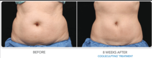 CoolSculpting Treatment on Nassau County, Long Island and Manhattan