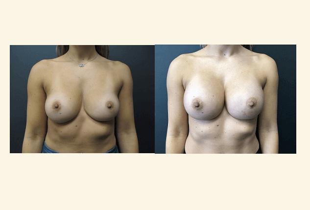 breast augmentation case 7 front view