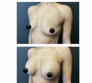 Breast aug with silcone implants