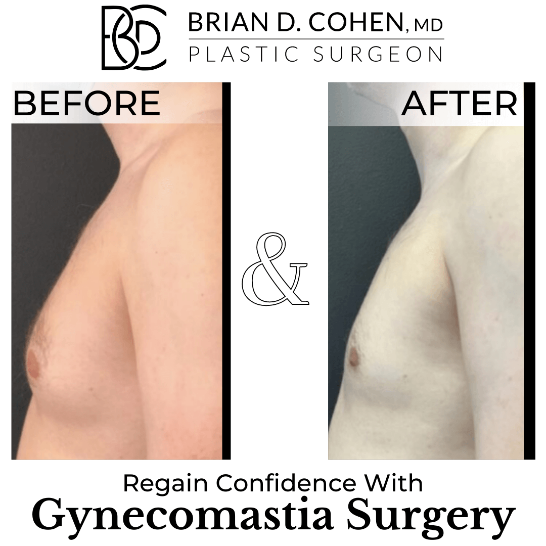 Gynecomastia Surgery on Long Island - Brian D. Cohen, MD