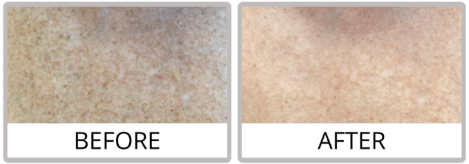 Before and after photo of Sciton Joule Laser treatment